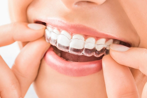Conventional & Invisible braces / Aligners