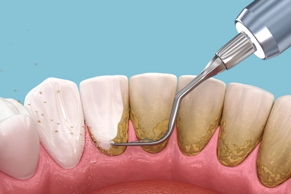 Gum disease treatment