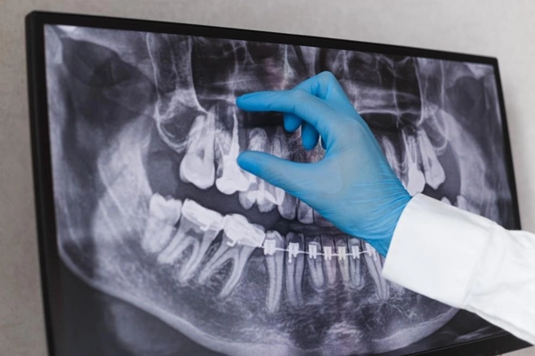 Failed root canal treatment.