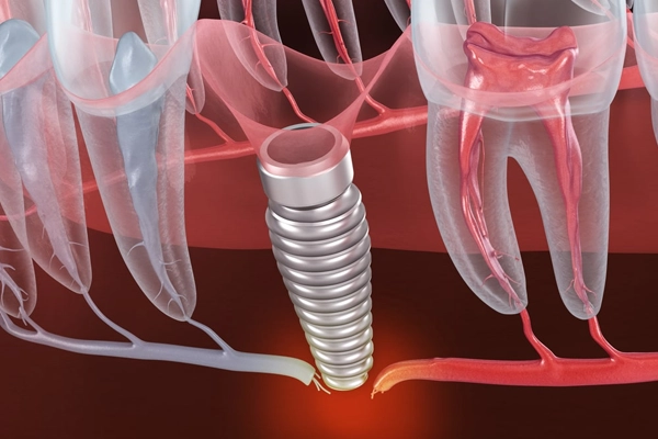 Failed Implant rehabilitation.