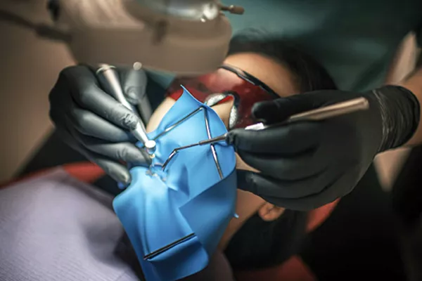 Single visit root canals