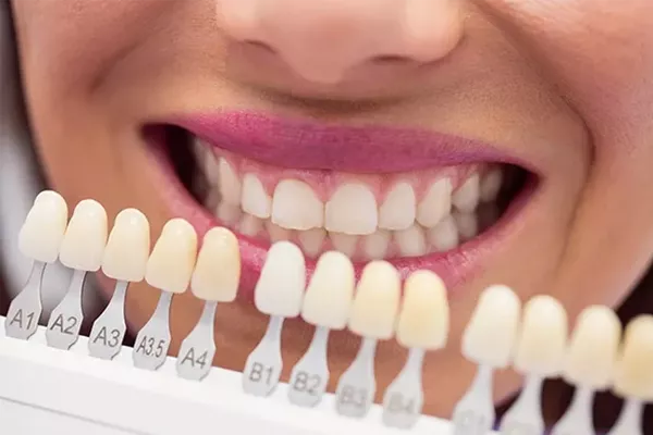 Crowns, Bridges and veneers