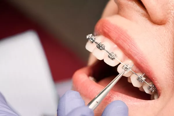 Orthodontic treatment