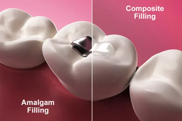 Tooth coloured restorations