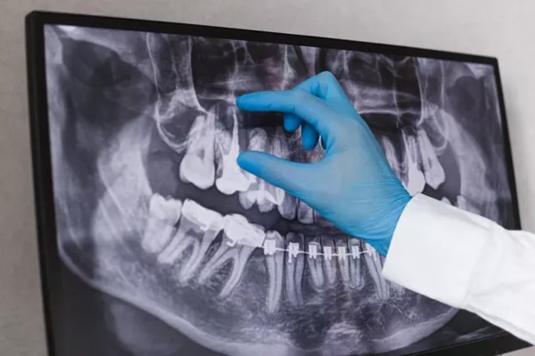 Failed root canal treatment.