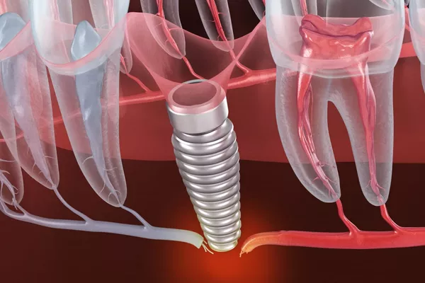 Failed Implant rehabilitation.