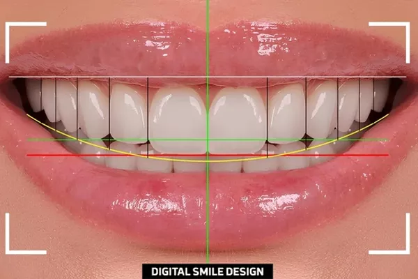 Smile designing